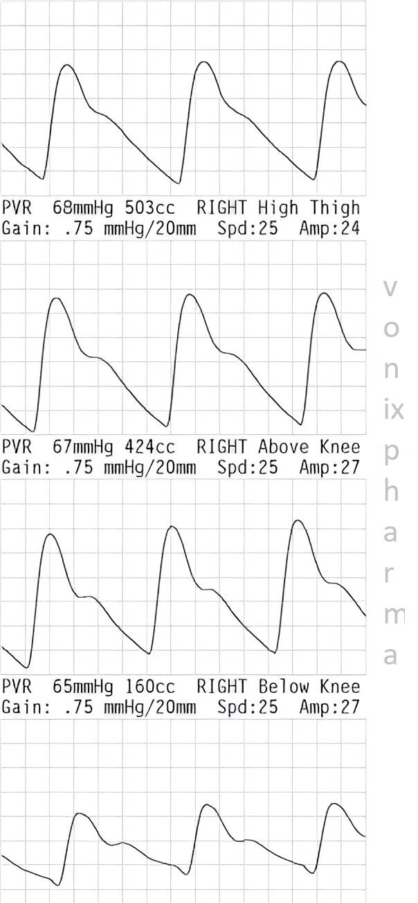 Plethysmographically Speaking: Insights into Vascular Health