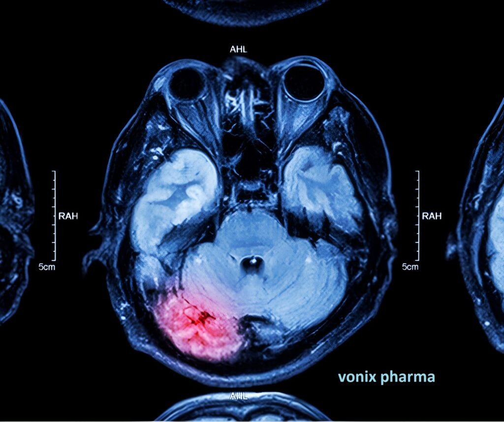 Blood on the Brain: Decoding Hemorrhagic Conversion in Cerebrovascular Events